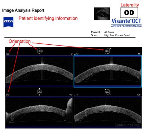 measuring corneal thickness with oct|anterior segment oct scan.